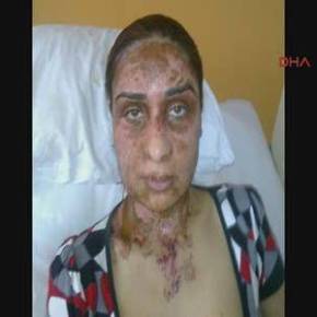 Τουρκία: ΕΠΙΘΕΣΕΙΣ ΜΕ ΟΞΥ ΣΕ&nbsp;ΓΥΝΑΙΚΕΣ