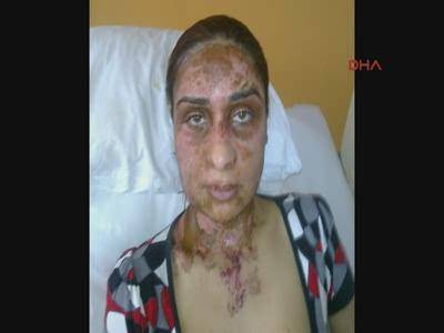 bosanma-davasi-acan-esinin-yuzune-kezzap-atti-53311