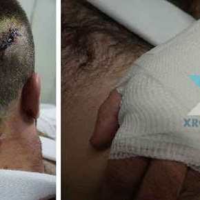 ΣΦΑΓΜΕΝΟΣ ΑΣΧΗΜΑ ο Αστυνομικός από τον Λαθρομετενάστη στη Ροδόπη… 5 μαχαιριές: 2 στην παλάμη, 1 στον ώμο και 2 στο&nbsp;κεφάλι